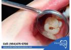 Expert Cavity Protection Service to Prevent Tooth Decay