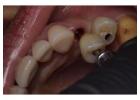 Find top-notch surgeons and dental equipment for Wisdom teeth removal Tijuana